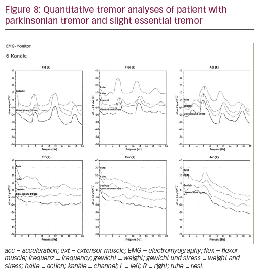 Figure 8: Quantitative tremor analyses of patient with parkinsonian tremor and slight essential tremor